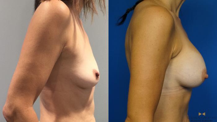 Before & After Breast Augmentation Case 347 Right Side View in Fort Worth & Arlington, Texas