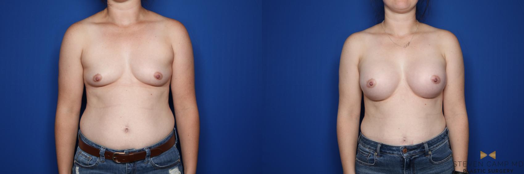 Before & After Breast Augmentation Case 349 Front View in Fort Worth & Arlington, Texas