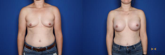 Before & After Breast Augmentation Case 349 Front View in Fort Worth & Arlington, Texas