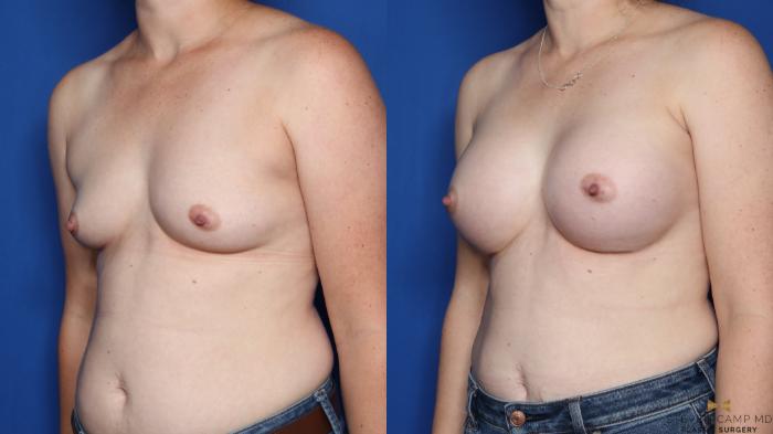 Before & After Breast Augmentation Case 349 Left Oblique View in Fort Worth & Arlington, Texas