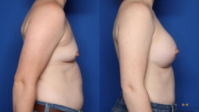 Before & After Breast Augmentation Case 349 Right Side View in Fort Worth & Arlington, Texas