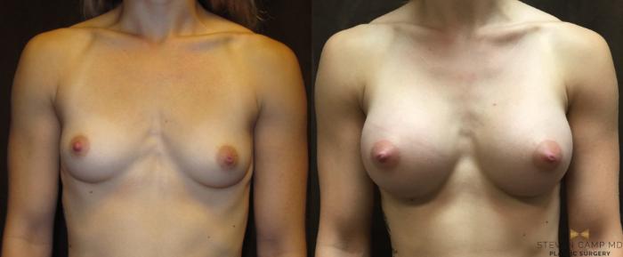 Before & After Breast Augmentation Case 35 View #1 View in Fort Worth & Arlington, Texas