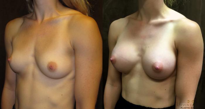 Before & After Breast Augmentation Case 35 View #2 View in Fort Worth, Texas