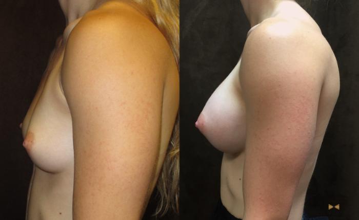 Before & After Breast Augmentation Case 35 View #3 View in Fort Worth, Texas