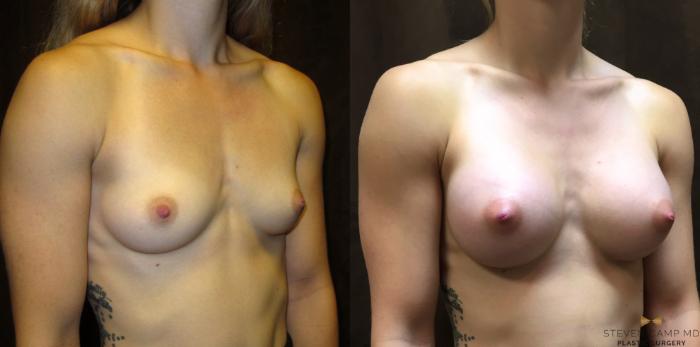 Before & After Breast Augmentation Case 35 View #4 View in Fort Worth, Texas