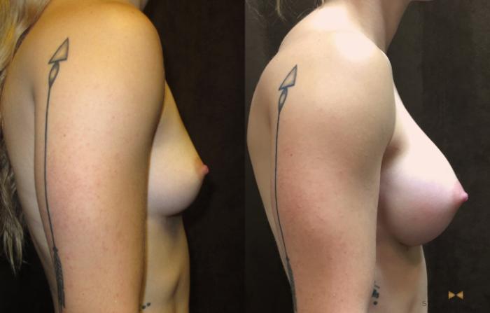 Before & After Breast Augmentation Case 35 View #5 View in Fort Worth & Arlington, Texas