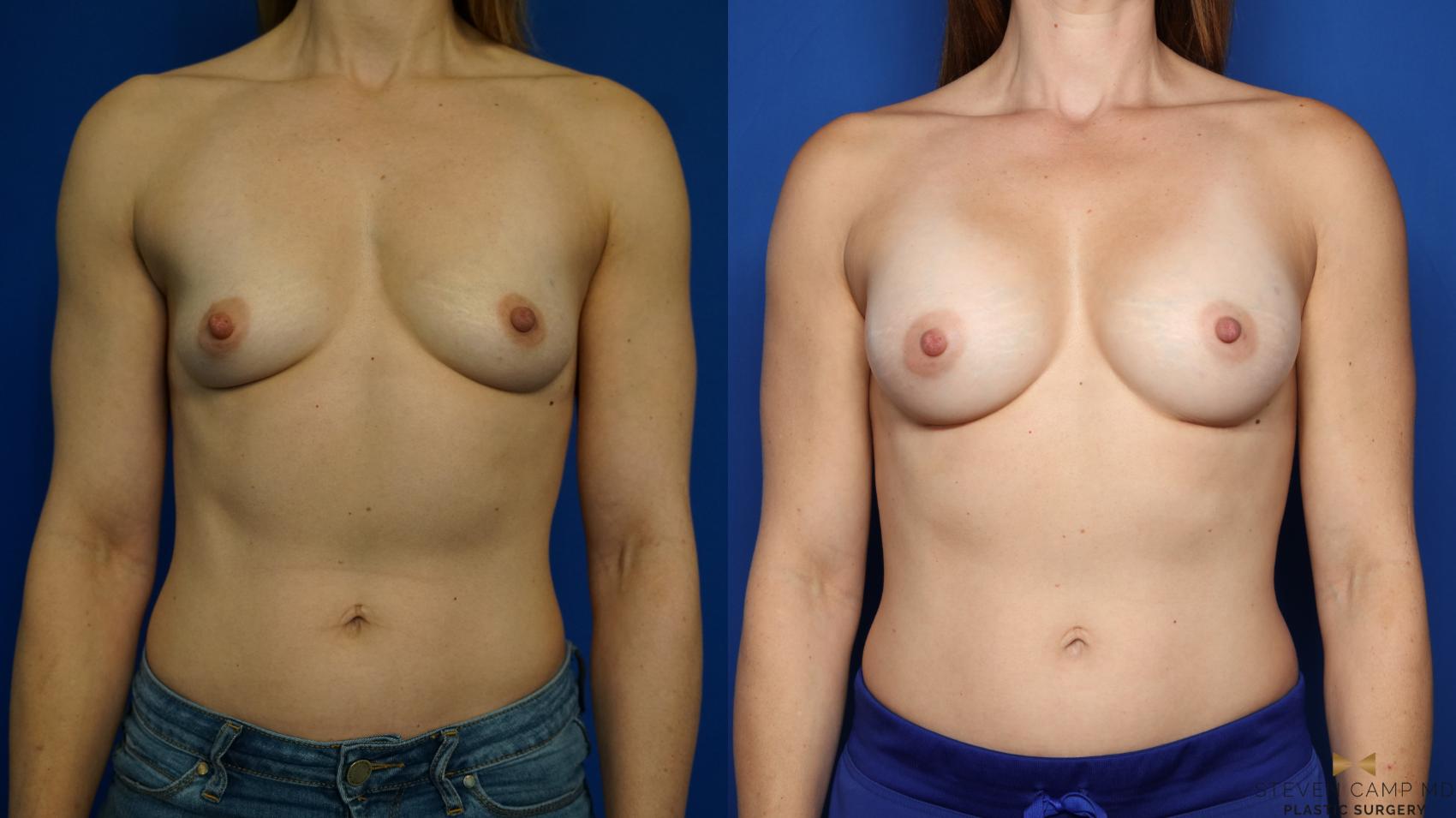 Before & After Breast Augmentation Case 350 Front View in Fort Worth & Arlington, Texas