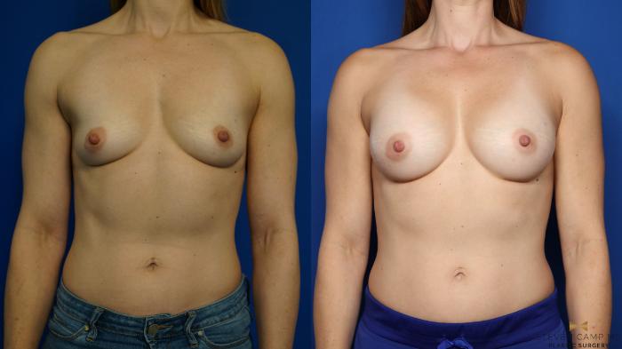 Before & After Breast Augmentation Case 350 Front View in Fort Worth & Arlington, Texas