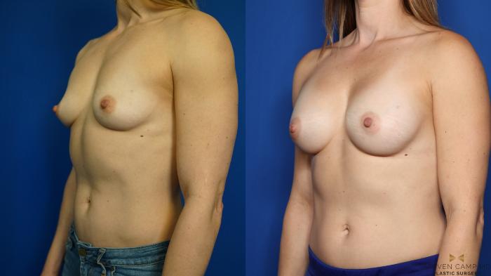 Before & After Breast Augmentation Case 350 Left Oblique View in Fort Worth & Arlington, Texas