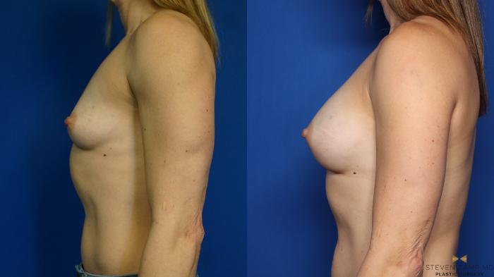 Before & After Breast Augmentation Case 350 Left Side View in Fort Worth & Arlington, Texas