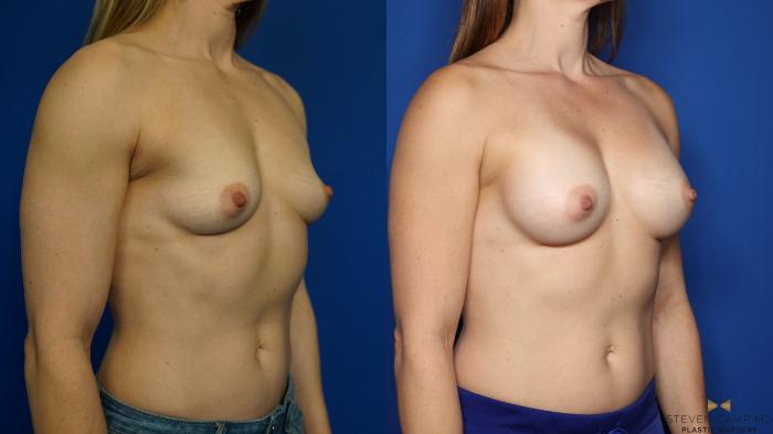 Before & After Breast Augmentation Case 350 Right Oblique View in Fort Worth & Arlington, Texas