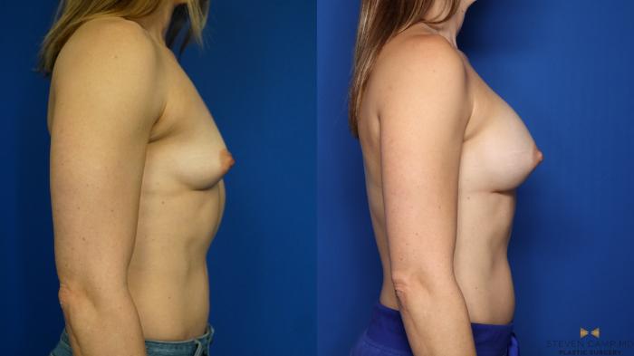 Before & After Breast Augmentation Case 350 Right Side View in Fort Worth & Arlington, Texas