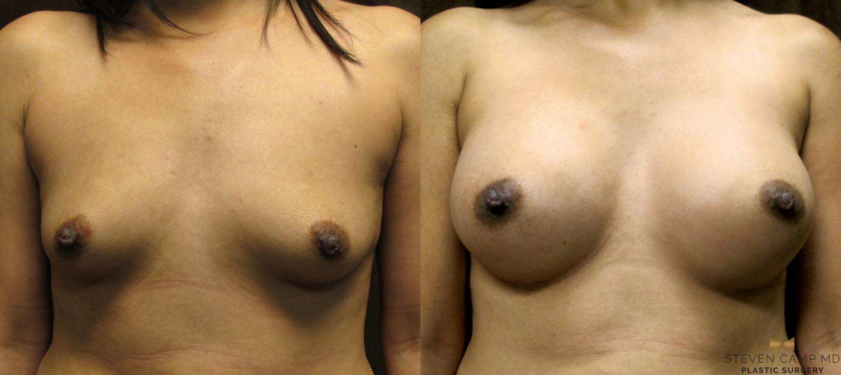 Before & After Breast Augmentation Case 36 View #1 View in Fort Worth, Texas
