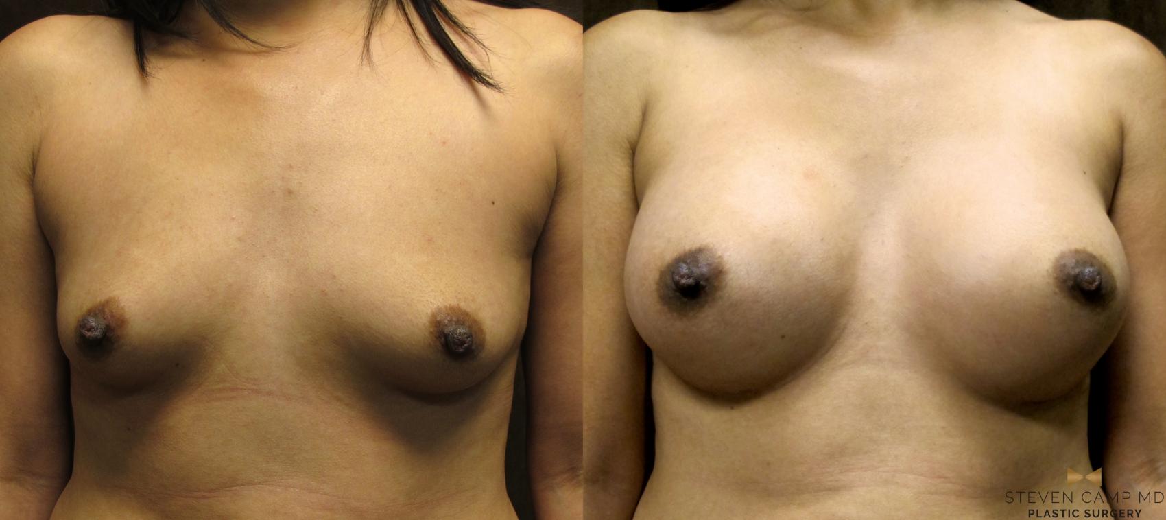 Before & After Breast Augmentation Case 36 View #1 View in Fort Worth & Arlington, Texas