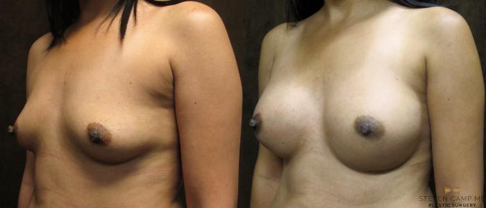 Before & After Breast Augmentation Case 36 View #2 View in Fort Worth, Texas