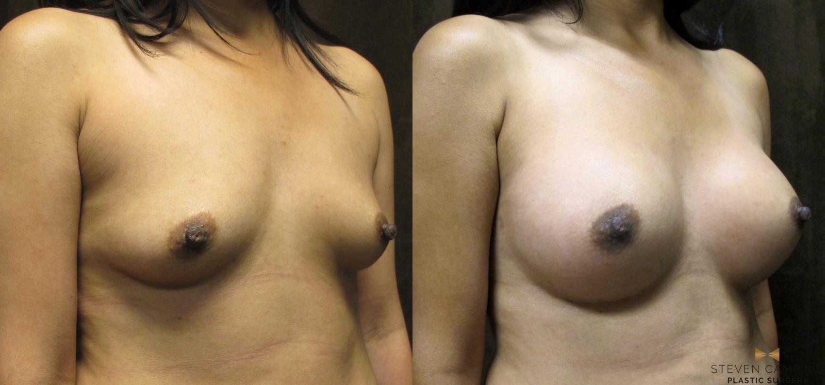 Before & After Breast Augmentation Case 36 View #4 View in Fort Worth & Arlington, Texas