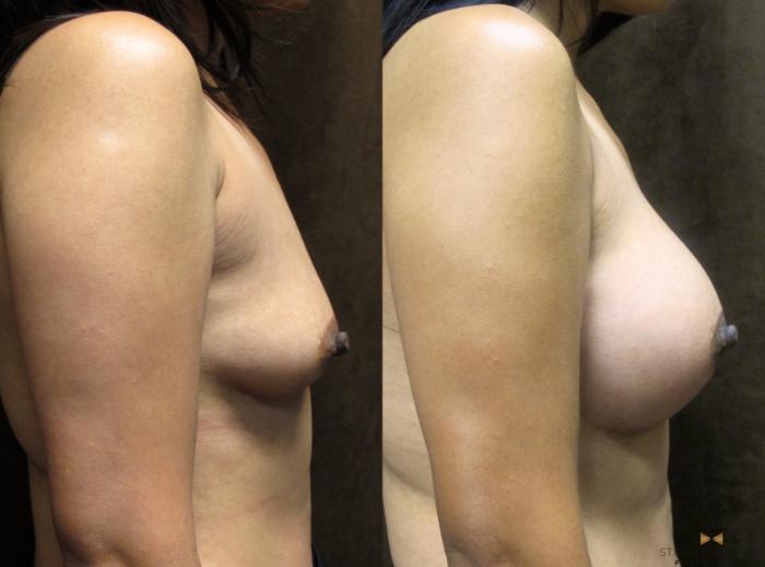 Before & After Breast Augmentation Case 36 View #5 View in Fort Worth, Texas