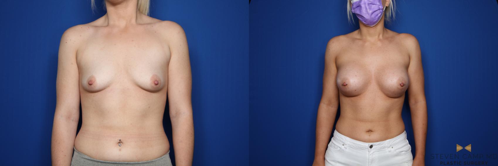 Before & After Breast Augmentation Case 399 Front View in Fort Worth & Arlington, Texas