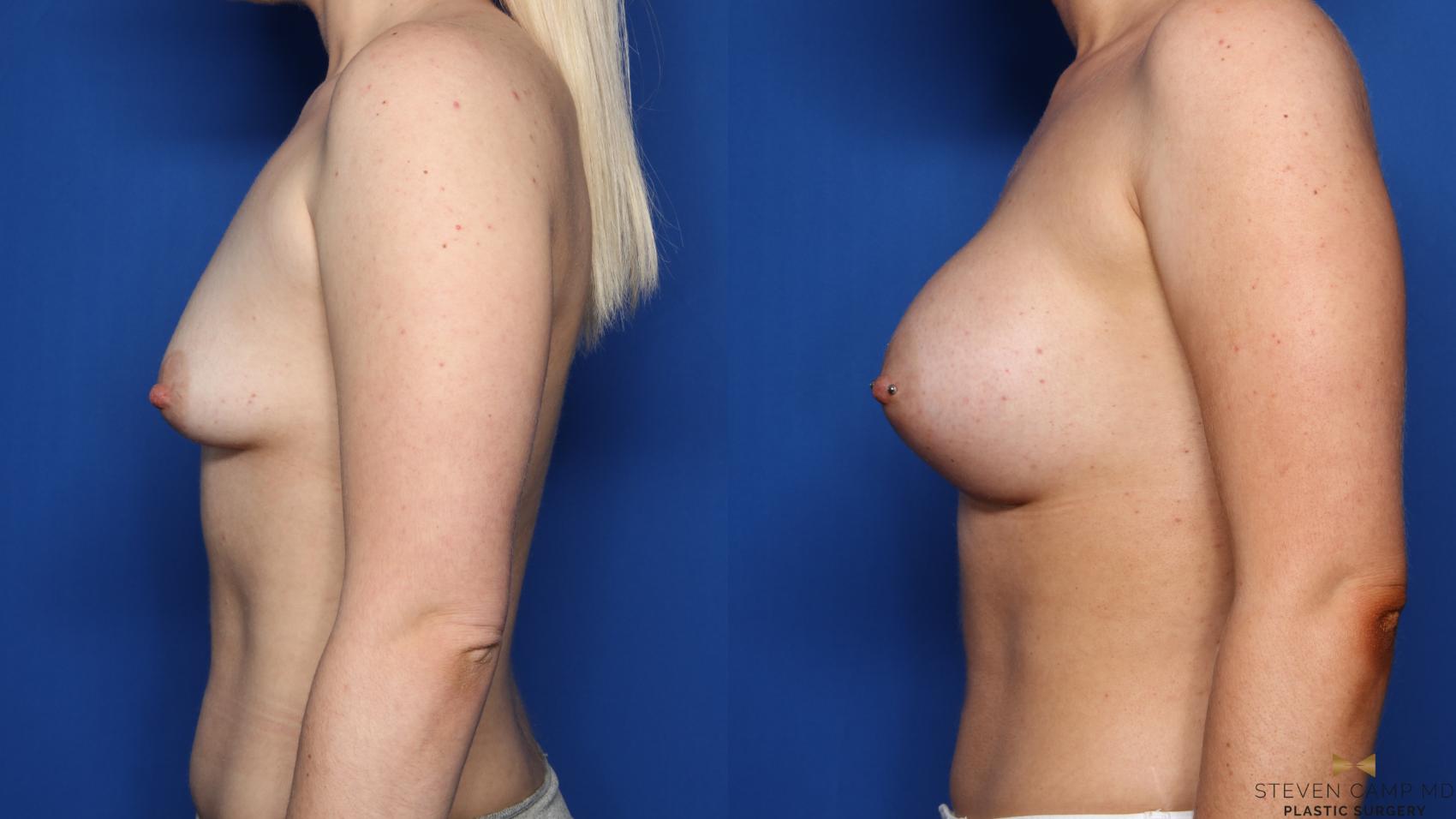 Before & After Breast Augmentation Case 399 Left Side View in Fort Worth, Texas