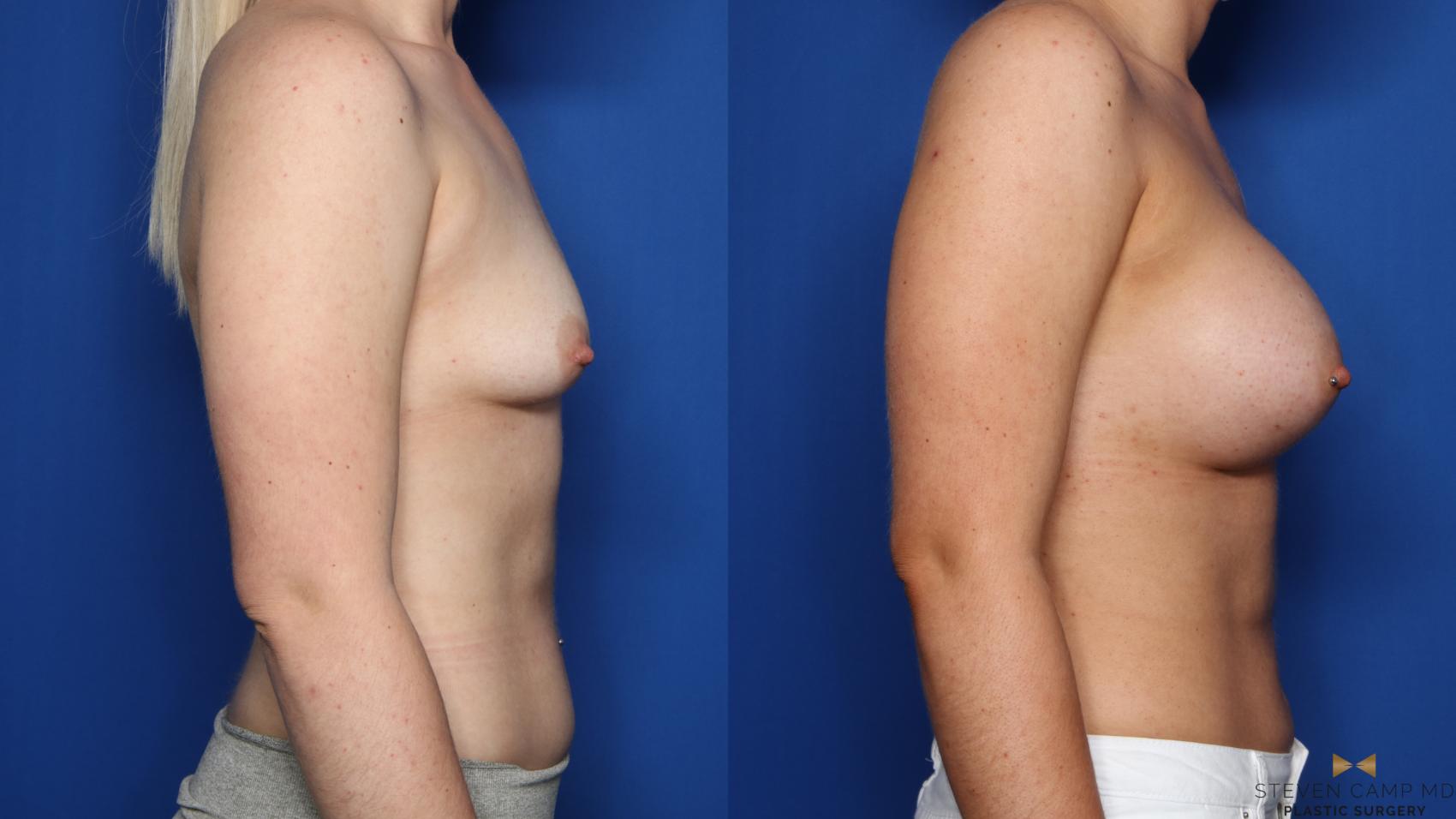 Before & After Breast Augmentation Case 399 Right Side View in Fort Worth & Arlington, Texas