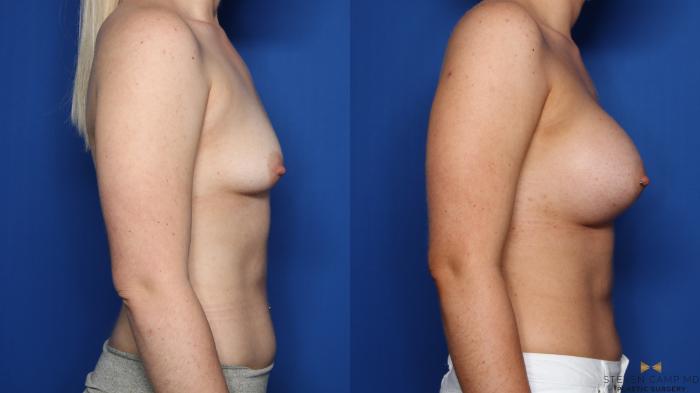 Before & After Breast Augmentation Case 399 Right Side View in Fort Worth, Texas