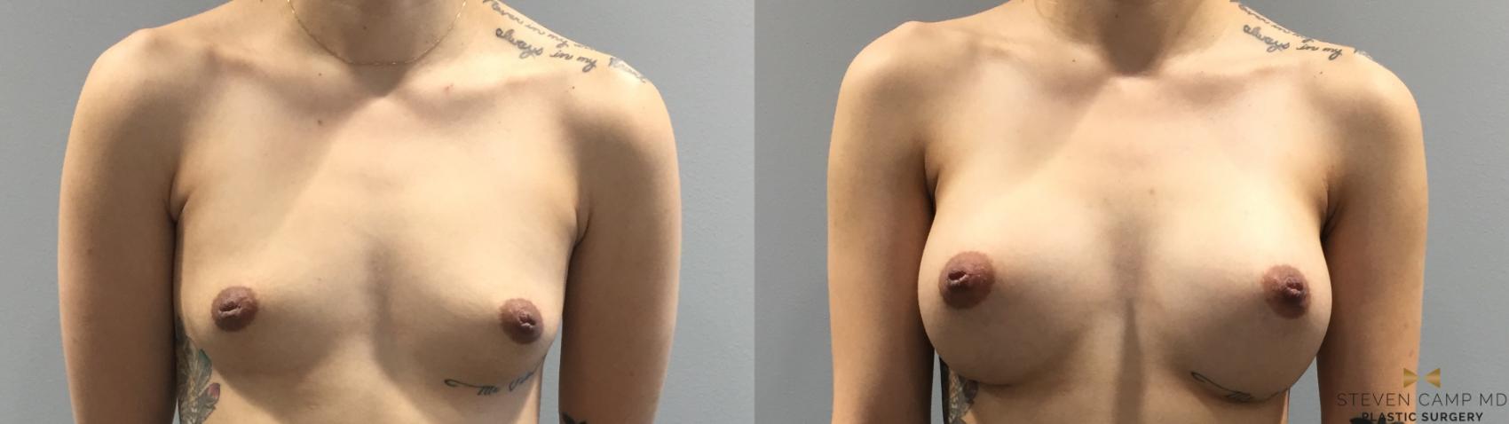 Before & After Breast Augmentation Case 400 Front View in Fort Worth & Arlington, Texas