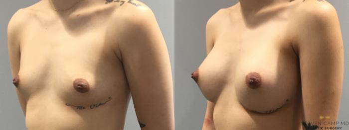 Before & After Breast Augmentation Case 400 Left Oblique View in Fort Worth & Arlington, Texas