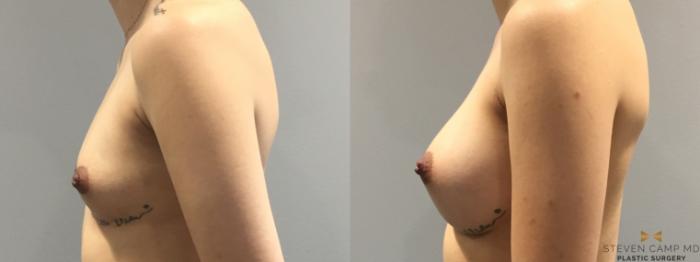 Before & After Breast Augmentation Case 400 Left Side View in Fort Worth & Arlington, Texas