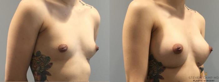 Before & After Breast Augmentation Case 400 Right Oblique View in Fort Worth & Arlington, Texas