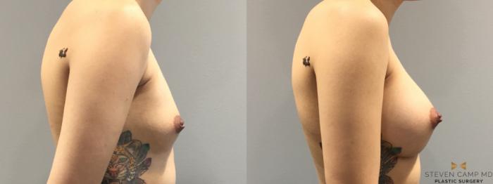 Before & After Breast Augmentation Case 400 Right Side View in Fort Worth & Arlington, Texas