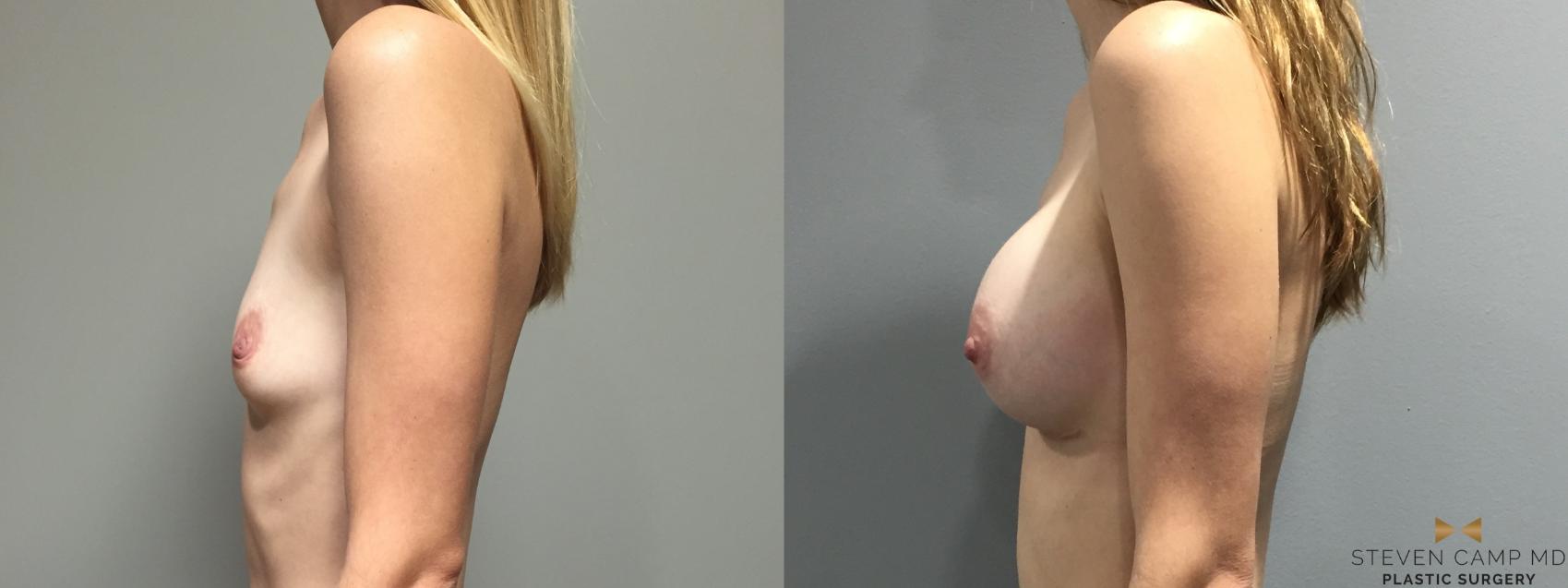 Before & After Breast Augmentation Case 401 Left Side View in Fort Worth & Arlington, Texas