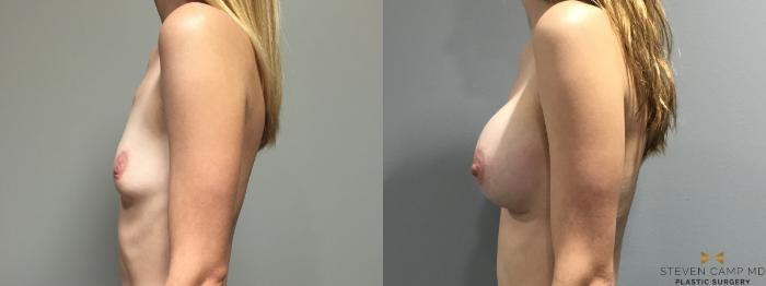 Before & After Breast Augmentation Case 401 Left Side View in Fort Worth, Texas