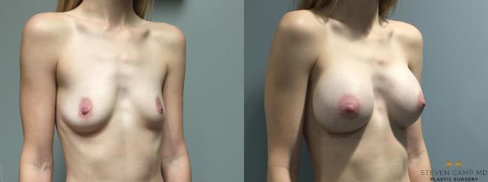 Before & After Breast Augmentation Case 401 Right Oblique View in Fort Worth, Texas