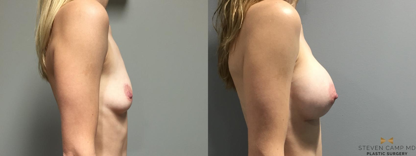 Before & After Breast Augmentation Case 401 Right Side View in Fort Worth & Arlington, Texas