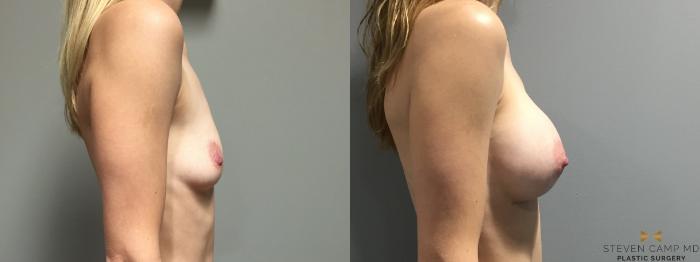 Before & After Breast Augmentation Case 401 Right Side View in Fort Worth, Texas