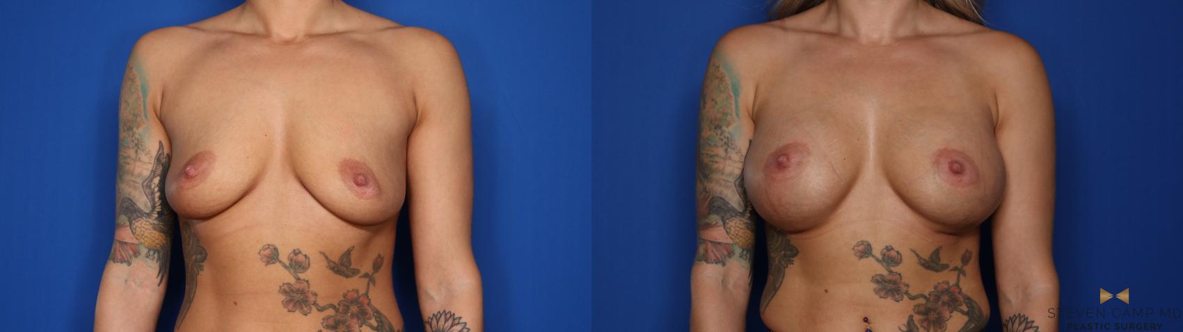 Before & After Breast Augmentation Case 403 Front View in Fort Worth & Arlington, Texas