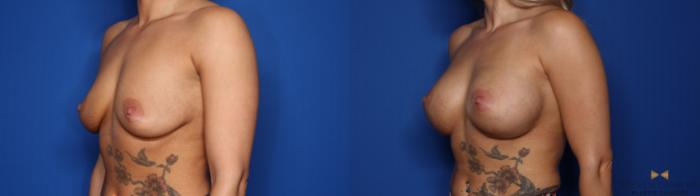 Before & After Breast Augmentation Case 403 Left Oblique View in Fort Worth & Arlington, Texas