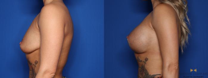 Before & After Breast Augmentation Case 403 Left Side View in Fort Worth & Arlington, Texas