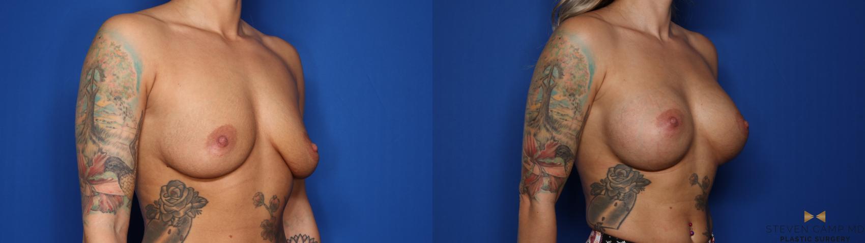 Before & After Breast Augmentation Case 403 Right Oblique View in Fort Worth & Arlington, Texas
