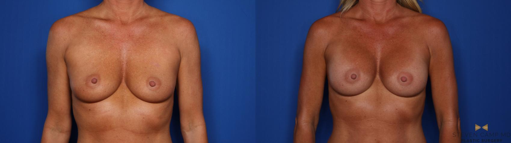 Before & After Breast Augmentation Case 404 Front View in Fort Worth & Arlington, Texas