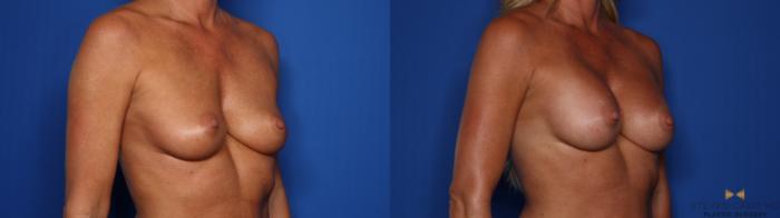 Before & After Breast Augmentation Case 404 Right Oblique View in Fort Worth & Arlington, Texas
