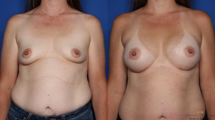 Before & After Breast Augmentation Case 417 Front View in Fort Worth & Arlington, Texas