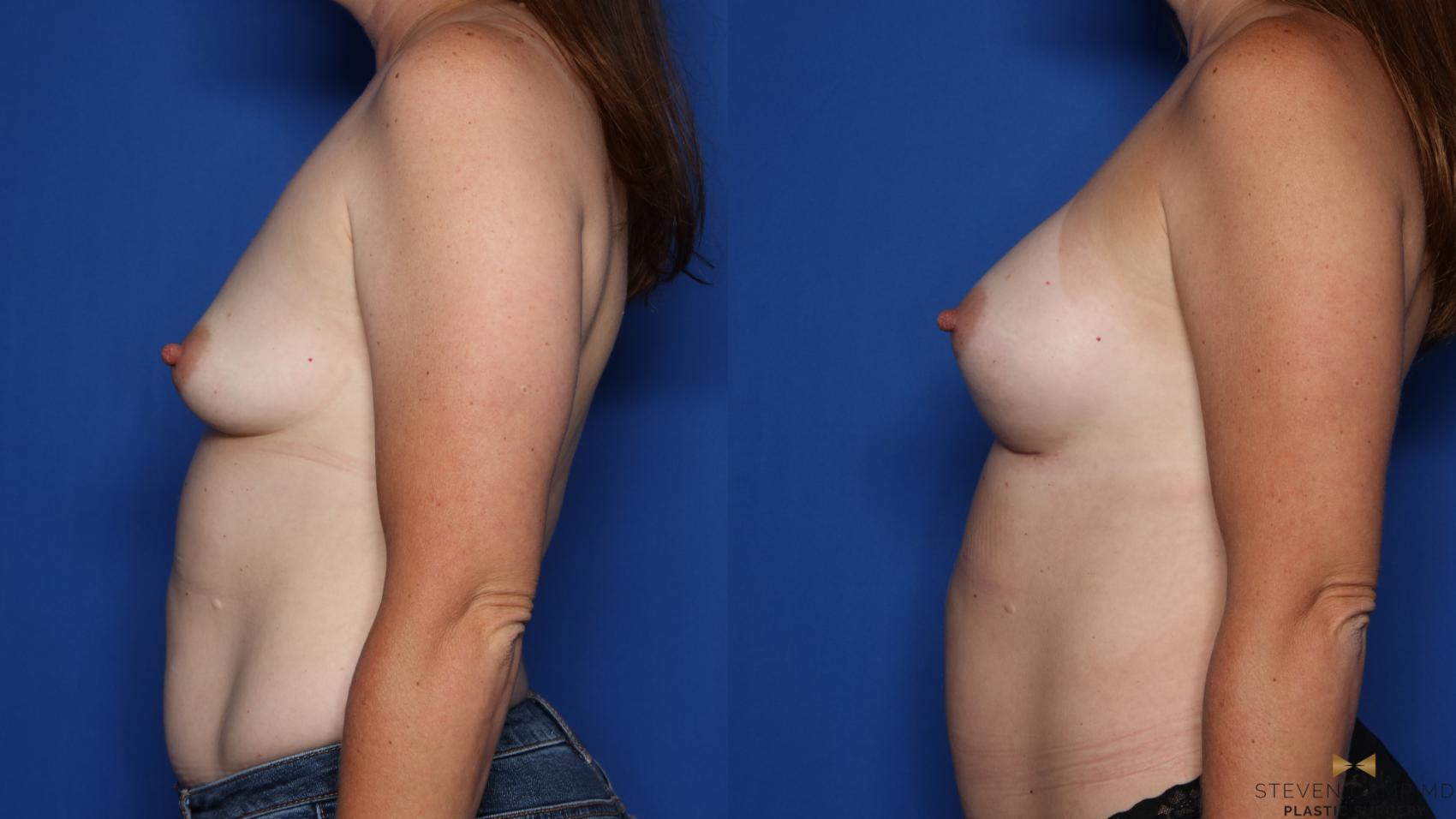 Before & After Breast Augmentation Case 417 Left Side View in Fort Worth & Arlington, Texas