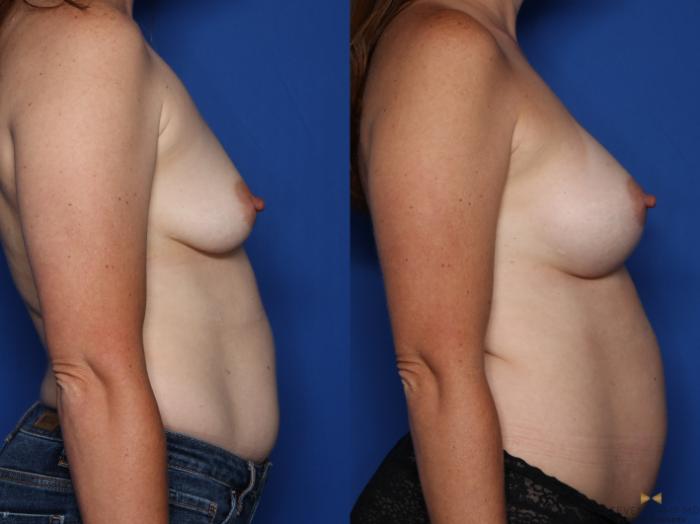 Before & After Breast Augmentation Case 417 Right Side View in Fort Worth & Arlington, Texas