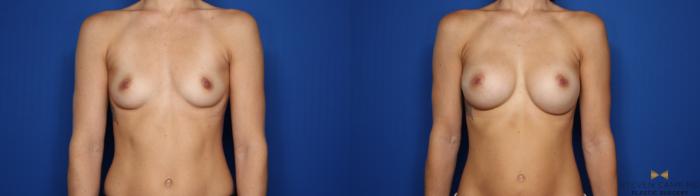 Before & After Breast Augmentation Case 423 Front View in Fort Worth & Arlington, Texas