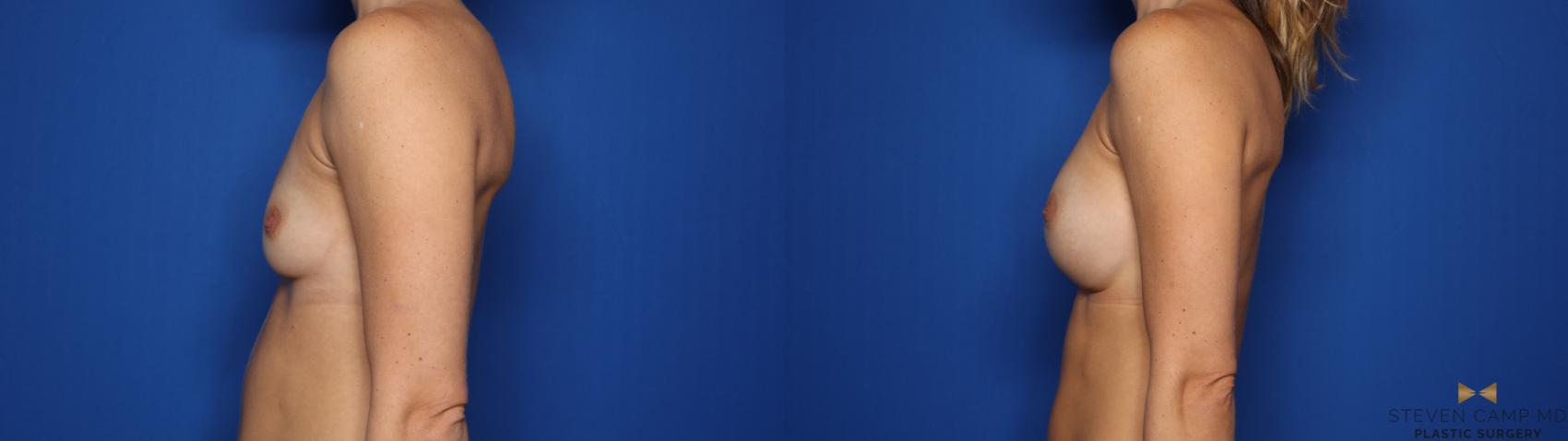 Before & After Breast Augmentation Case 423 Left Side View in Fort Worth & Arlington, Texas