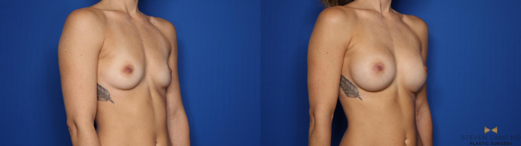 Before & After Breast Augmentation Case 423 Right Oblique View in Fort Worth & Arlington, Texas