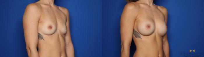 Before & After Breast Augmentation Case 423 Right Oblique View in Fort Worth & Arlington, Texas