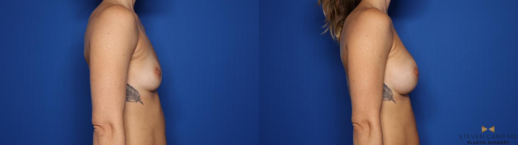 Before & After Breast Augmentation Case 423 Right Side View in Fort Worth & Arlington, Texas