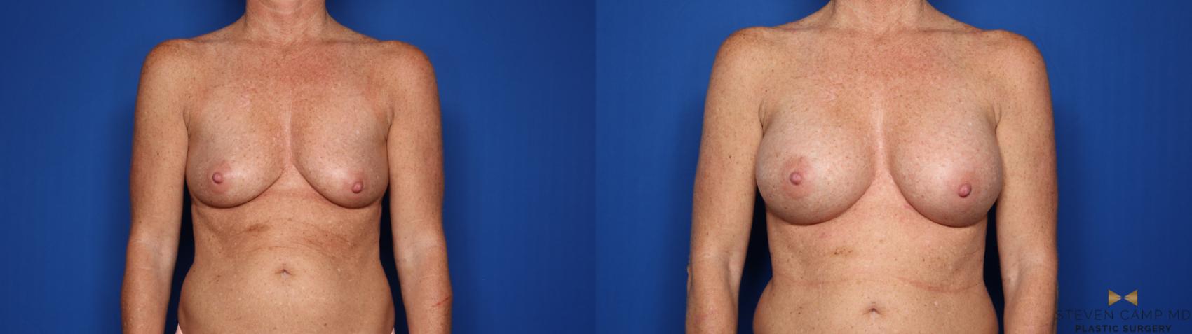 Before & After Breast Augmentation Case 424 Front View in Fort Worth, Texas